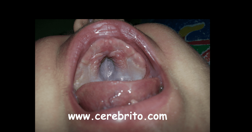 paladar, ojival, hundido, duro, blando