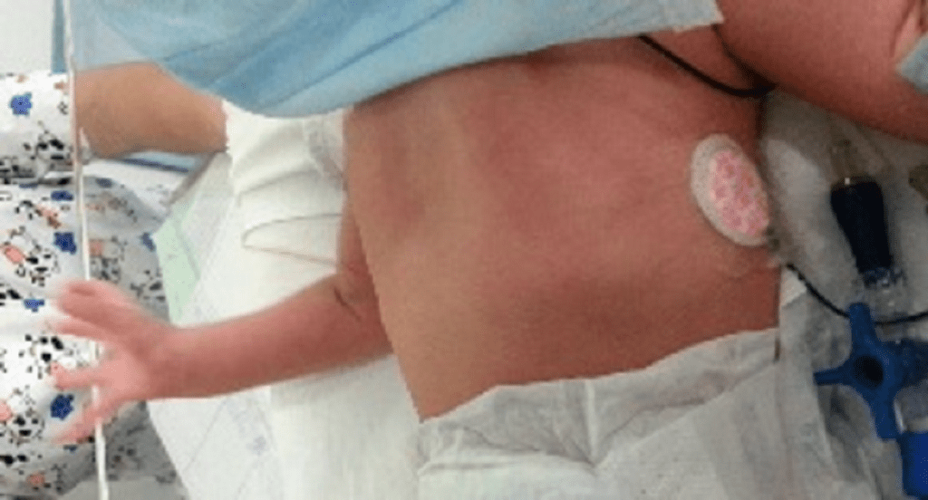 disquinesias, movimientos, anormales, incoordinados, coordinación